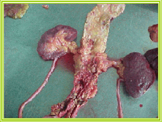 Lesiones aterosclerticas - Ateroma grave en porcin abdominal de aorta